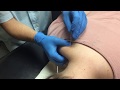 Functional Dry Needling and Headaches