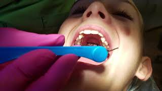 Tightening a Palatal Expander in Your Mouth