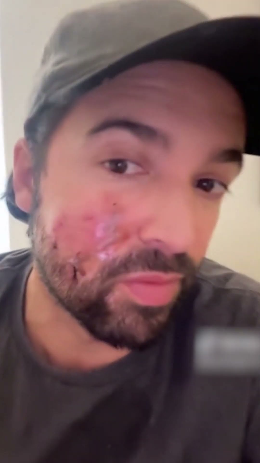 Actor de #ComoDiceElDicho fue atacado por un perro ? #CarlosGirón #CuéntameloYa