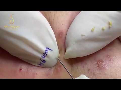 ACNE REMOVAL BLACKHEADS AND whiteheads (94) | Loan Nguyen