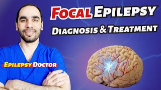 Focal Or Partial Epilepsy Diagnosis And Treatment