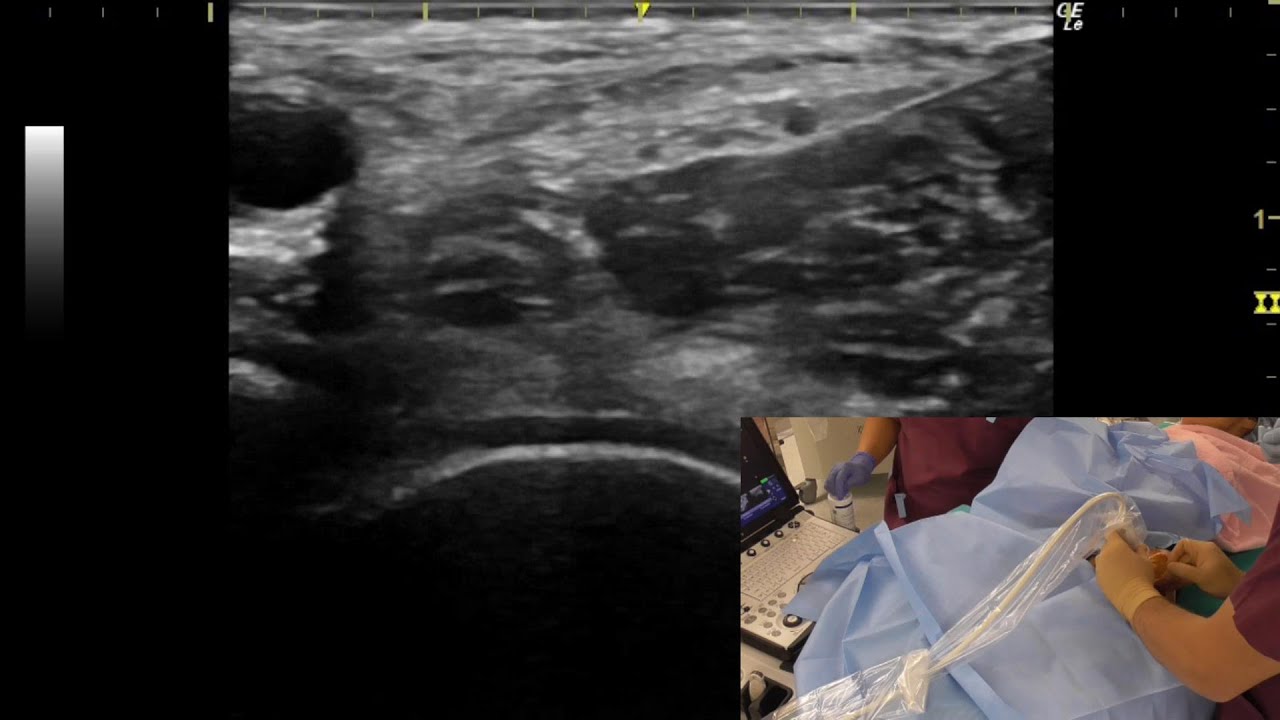 神経ブロック】大腿神経ブロック_エコーガイド下 - YouTube