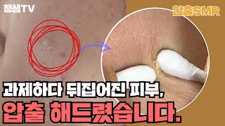 [압출smr] 106. 피곤해서 생기는 염증성 여드름 압출 ( 20대 女 )