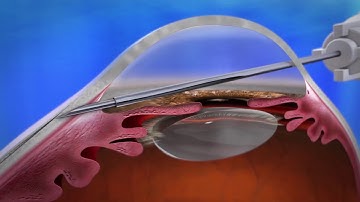 Xen Gel Stent