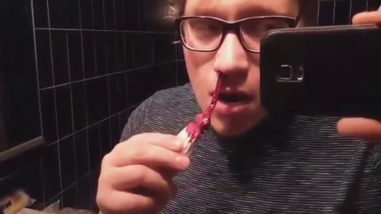 TOP 10 MOST VIEWED POPPING VIDEO ON REDDIT COM ZITS, PIMPLES, CYSTS and
