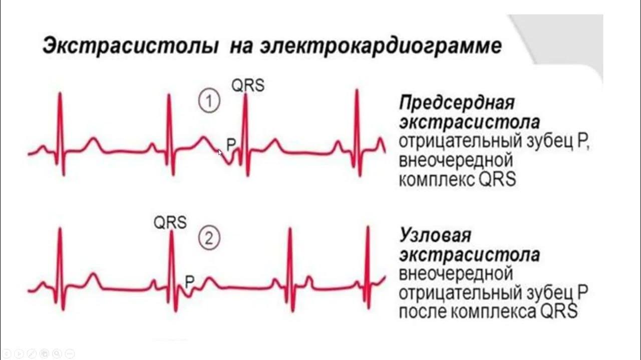 Экстрасистолы много. Наджелудочковая экстрасистола на ЭКГ. Экстрасистола желудочков на ЭКГ. Наджелудочковая экстрасистолия на ЭКГ. Одиночная наджелудочковая экстрасистолия на ЭКГ.