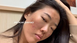 Suffering From Acne? Watch This | My Acne Journey