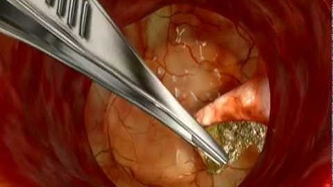 Animation: Cholesteatoma Removal from Stapes Bone