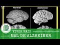 Conheça os primeiros sintomas do mal de Alzheimer