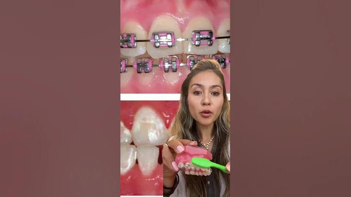 How to Prevent White Spots On Teeth After Braces