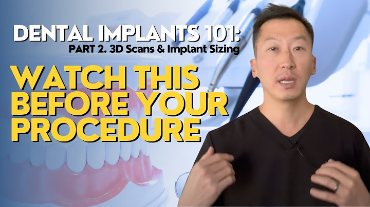 Top things you should know about dental implants