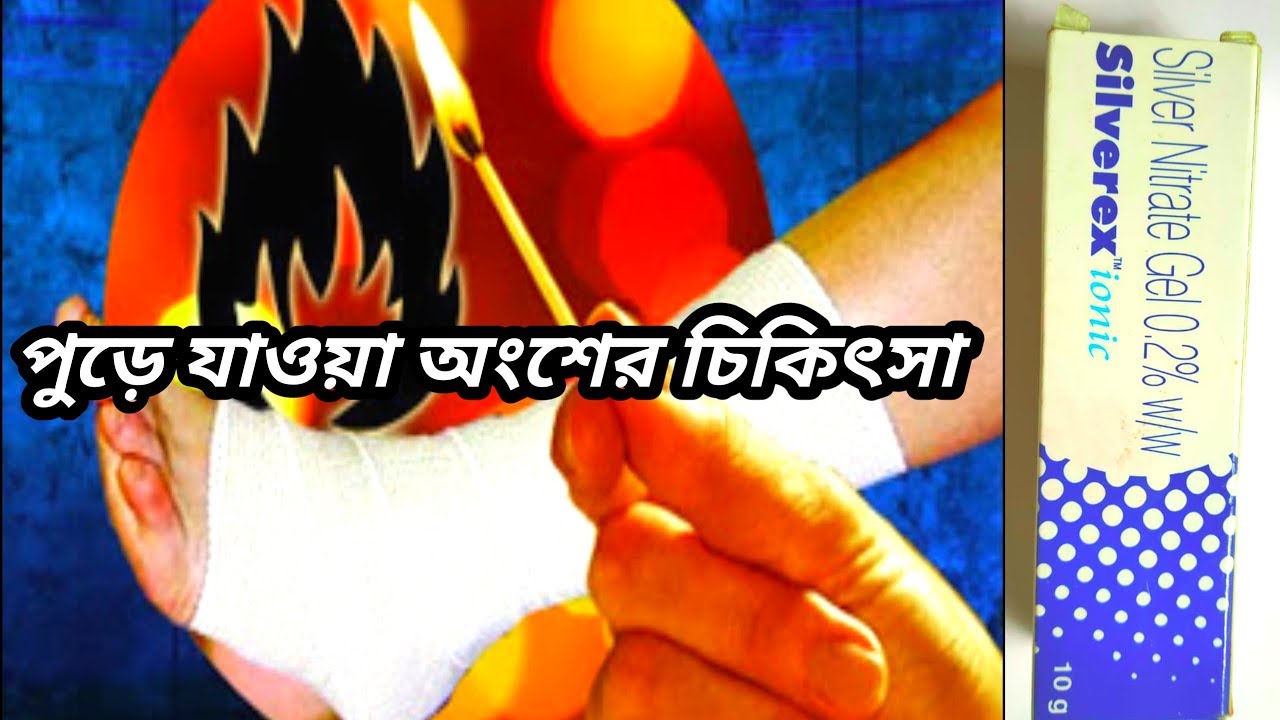 Treatment of burn pats. Silverex ionic gel . Silver Nitrate Gel