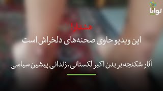 آثار شکنجه بر بدن اکبر لکستانی، زندانی پیشین سیاسی