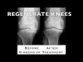 REGENERATE YOUR KNEES | NO SURGERY