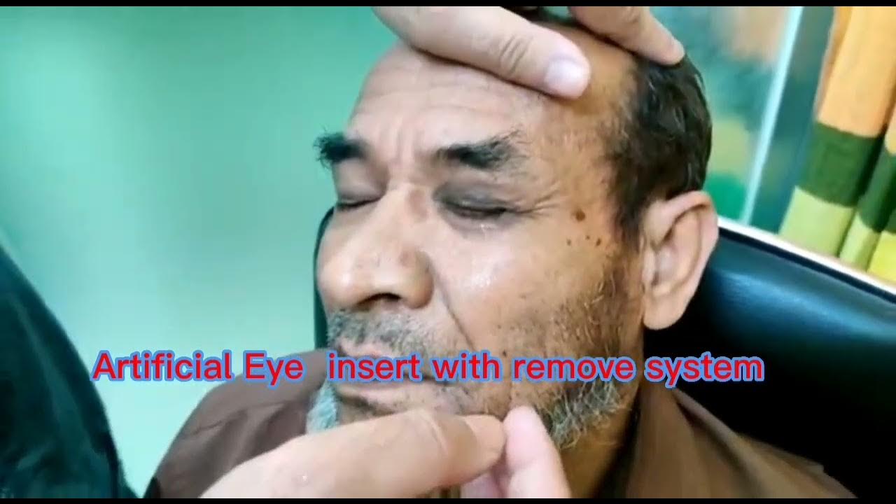 Artificial eye in Bangladesh, artificial eye, কৃত্রিম চক্ষু সংযোজন
