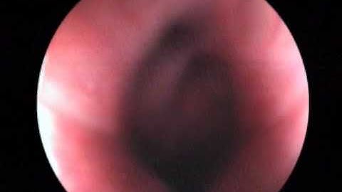 Colonic pseudo polyps with ulcerative colitis at partial remission phase