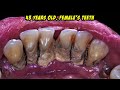 Pleasing Scaling Process | Tartar | Dentist | Dokter Gigi Tri Putra