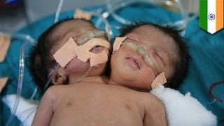 Двухголовая девочка умерла через три недели после рождения. Двухголовая девочка умерла через три недели после рождения.