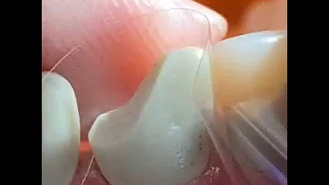 Class IV Composite- Quick 1 minute Tip