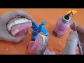 Enfilado de dientes artificiales en prótesis total, Maxilar superior. Parte1