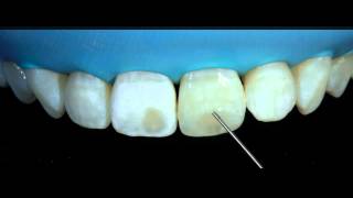 Removal of white spots on teeth with DMG ICON