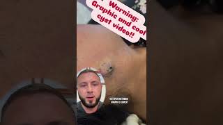 Мнение врача-онколога про удаление атеромы соседом #медицина #атерома #медгард_оренбург #хирург