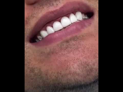 Видео: Можно ли люминиры удлинить зубы?