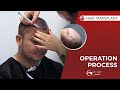 5000 Grafts in One Session - Hair Transplant in Istanbul