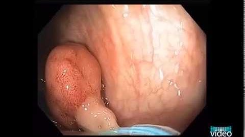 Endoloop-Assisted Polypectomy Technique