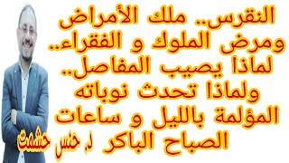 تاريخ النقرس/كل ما يجب معرفته عن النقرس/أسبابه/أكثر الناس عرضةله/الأدويةالمسببةله/هل السمنة مسببة له