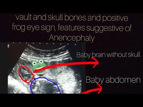 Video: Bolehkah ultrasound menyakiti bayi?