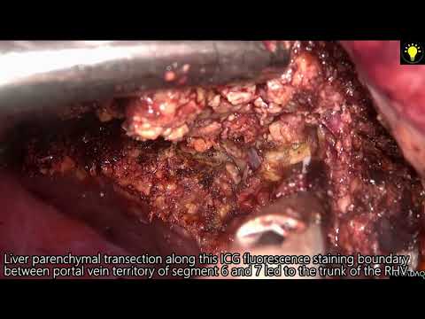 LAPAROSCOPIC ANATOMICAL RESECTION OF LIVER SEGMENT 7 USING IN SITU SPLIT BASED ON PORTAL VEIN TERRIT
