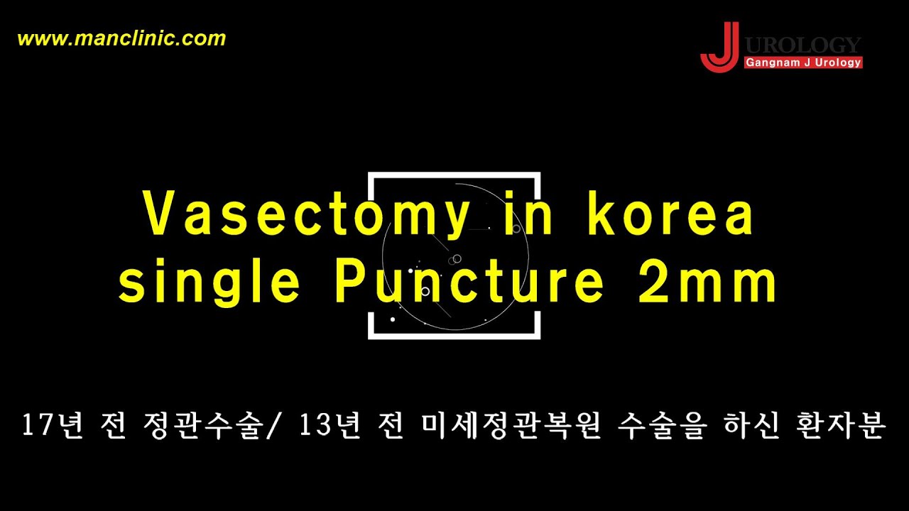 Vasectomy in korea single Puncture 2mm 17년 전 정관수술/ 13년 전 미세정관복원 수술을