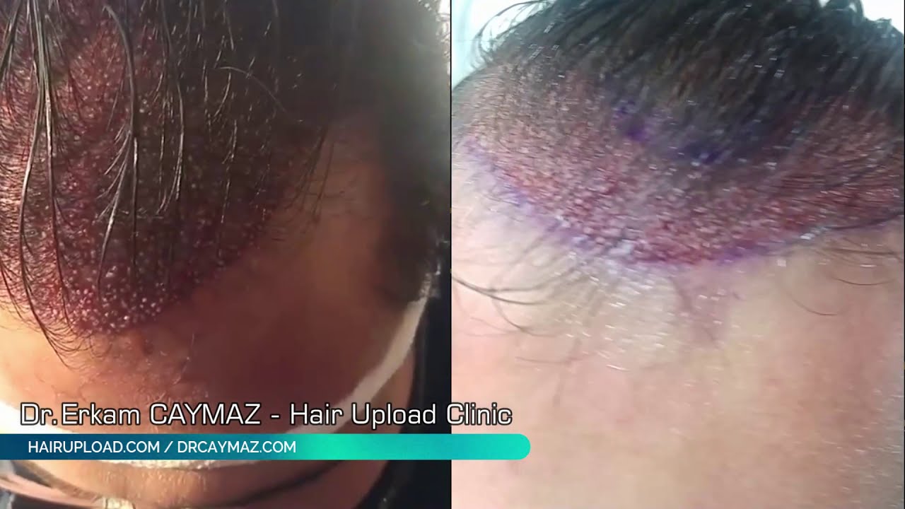 Unshaven Operation - DHI Technique Hair Implantation Turkey