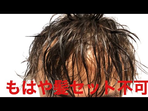【全ハゲが共感？】若ハゲが語るハゲあるある