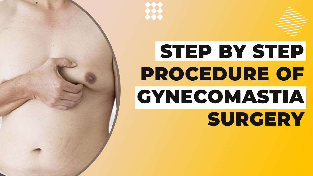 Gynecomastia Surgery - a Guy's Guide