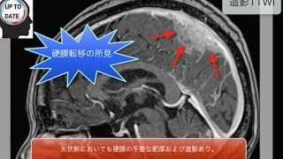 転移性脳腫瘍(脳転移)のMRI画像診断｜原発巣・好発部位・造影所見と鑑別