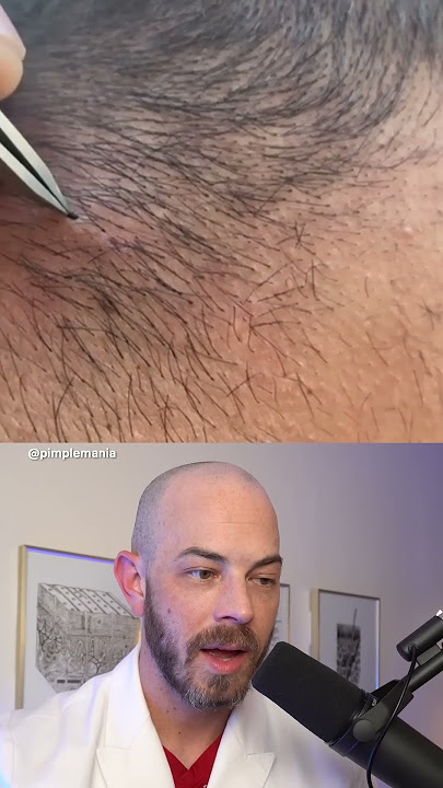 Derm reacts to BIG ingrown hair! #dermreacts #doctorreacts #ingrownhair