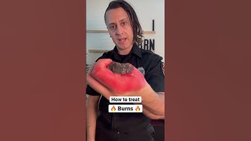 Thumbnail of Burned your skin? Do this… #health #survival