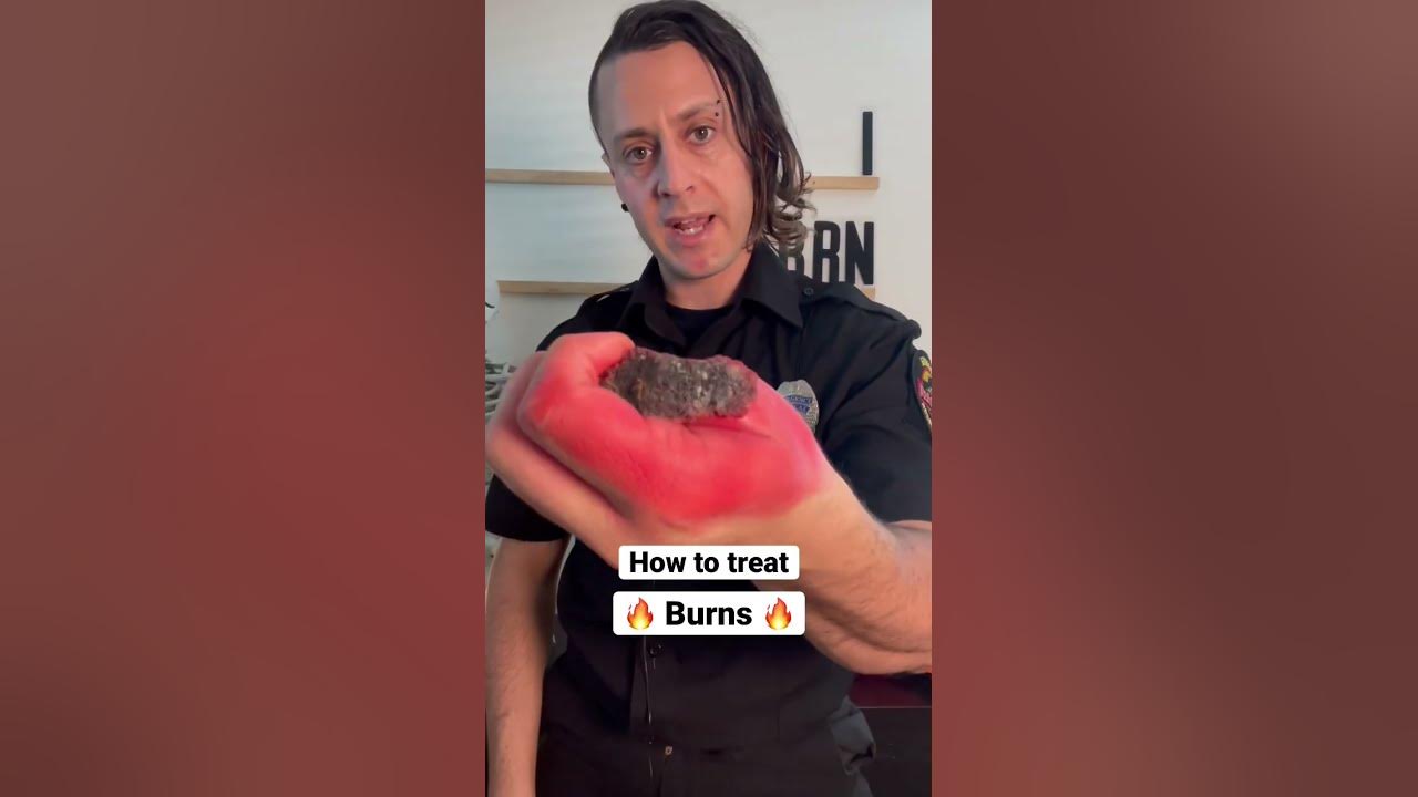 Burned your skin? Do this… #health #survival