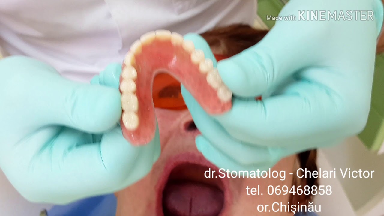 Stomatologie Chisinau, Botanica - TerraDent, Moldova!  Proteza mobilizabila pe implanturi dentare.