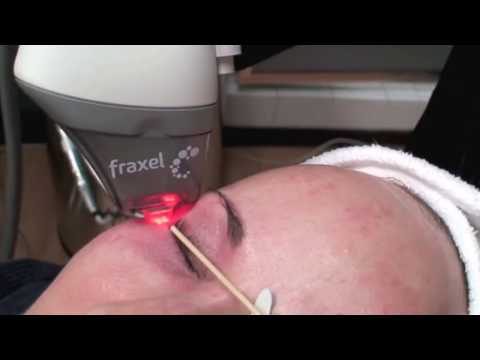 თვალის ირგვლივი სიშავეების მოცილება კოსმეტოლოგიური ლაზერით