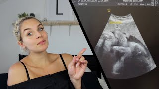 DÉNI DE GROSSESSE ( 1 an après ) 🤰🏼🤱🏼