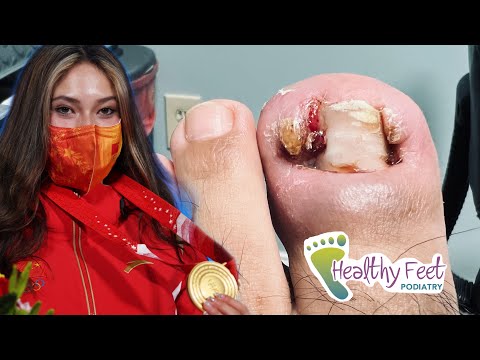 Video OLYMPIC SIZED INFECTION FROM INGROWN NAIL - youtube