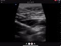 Infraclavicular block; oblique parasagital costoclavicular approach