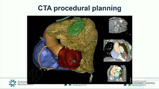 CVI 2019_Thursday 7/18_ Breaking Boundaries with Mitral Valve Therapy_Tilak Pasala, MD