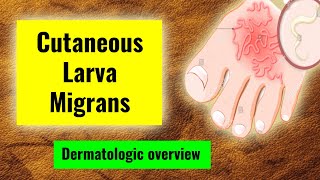 Cutaneous Larva Migrans Clinical Features, Associations, And Management