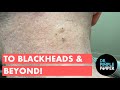 To Blackheads & Beyond!