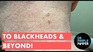 To Blackheads & Beyond! screenshot 1