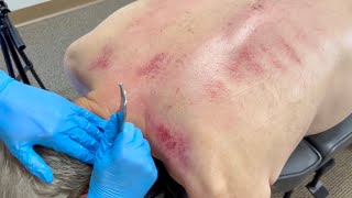 Asmr Severe Nerve Injury Cuased This